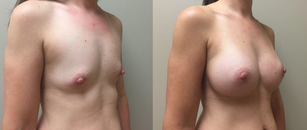 Breast Augmentation Patient 26a | Dr. Shaun Parson Plastic Surgery Scottsdale Arizona