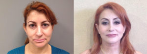 Facelift Patient 16 | Dr. Shaun Parson Plastic Surgery, Scottsdale, Arizona