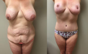 Mommy Makeover Patient 2 | Dr. Shaun Parson Plastic Surgery Scottsdale Arizona