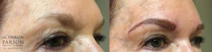 Microblading Patient 2 | Dr. Shaun Parson Plastic Surgery Scottsdale Arizona