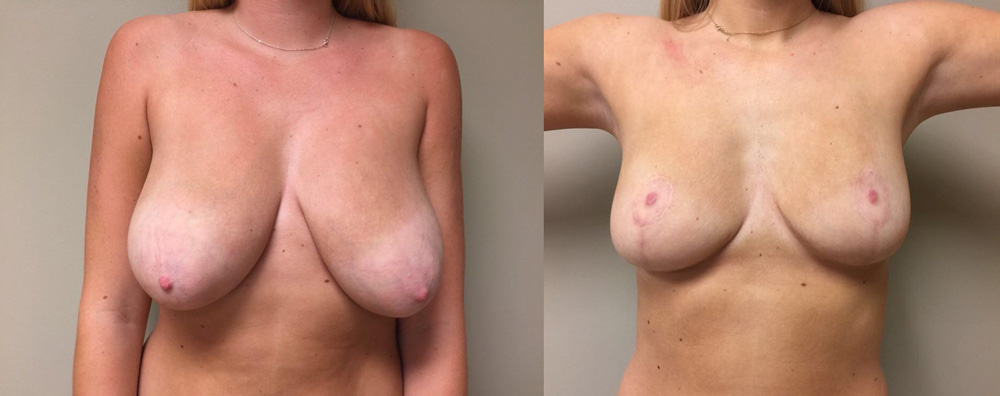 Breast Lift Patient 15 | Dr. Shaun Parson Plastic Surgery Scottsdale Arizona