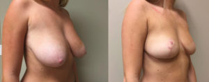Breast Lift Patient 15 | Dr. Shaun Parson Plastic Surgery Scottsdale Arizona