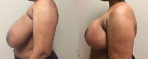 Breast Lift Patient 14 | Dr. Shaun Parson Plastic Surgery Scottsdale Arizona