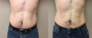 Liposuction Patient 14 | Dr. Shaun Parson Plastic Surgery Scottsdale Arizona