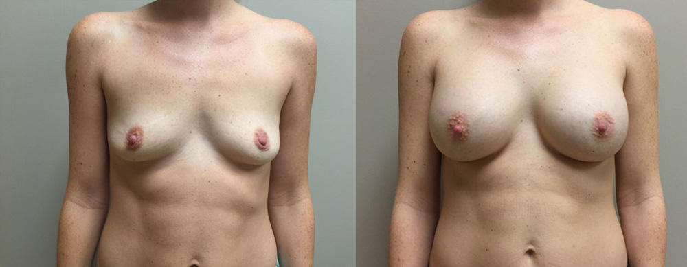 Breast Augmentation Patient 29 | Dr. Shaun Parson Plastic Surgery Scottsdale Arizona