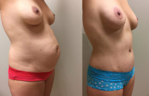 Tummy Tuck Patient 23 | Dr. Shaun Parson Plastic Surgery Scottsdale Arizona
