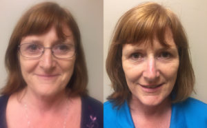Facelift Patient 17 | Dr. Shaun Parson Plastic Surgery, Scottsdale, Arizona
