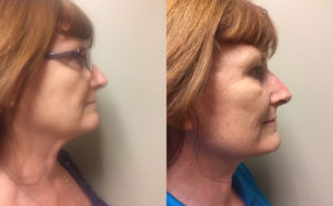 Facelift Patient 17 | Dr. Shaun Parson Plastic Surgery, Scottsdale, Arizona
