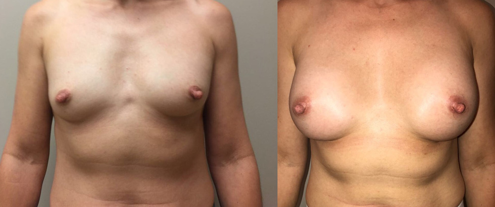 Breast Augmentation Patient 31 | Dr. Shaun Parson Plastic Surgery, Scottsdale, Arizona
