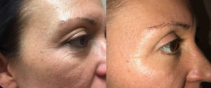 Eyelid Surgery Patient 22 | Dr. Shaun Parson Plastic Surgery, Scottsdale, Arizona