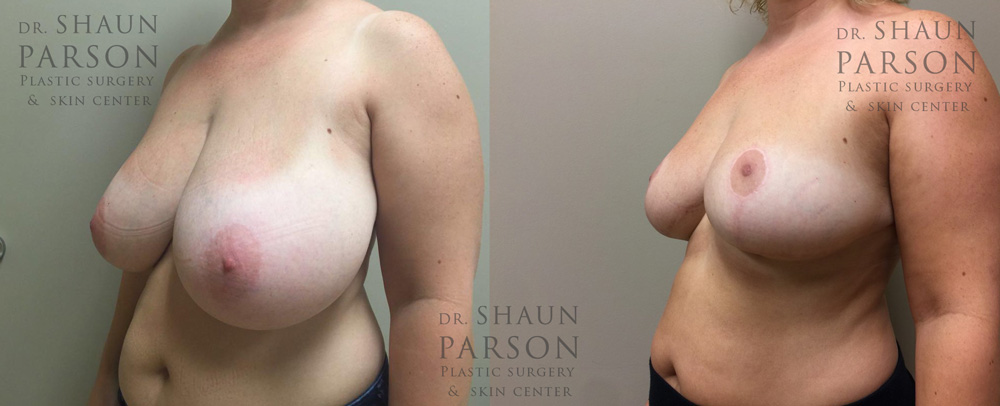 Breast Lift Patient 17 | Dr. Shaun Parson Plastic Surgery, Scottsdale, Arizona