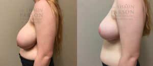 Breast Lift Patient 16 | Dr. Shaun Parson Plastic Surgery, Scottsdale, Arizona