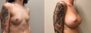 Breast Augmentation Patient 32 | Dr. Shaun Parson Plastic Surgery, Scottsdale, Arizona