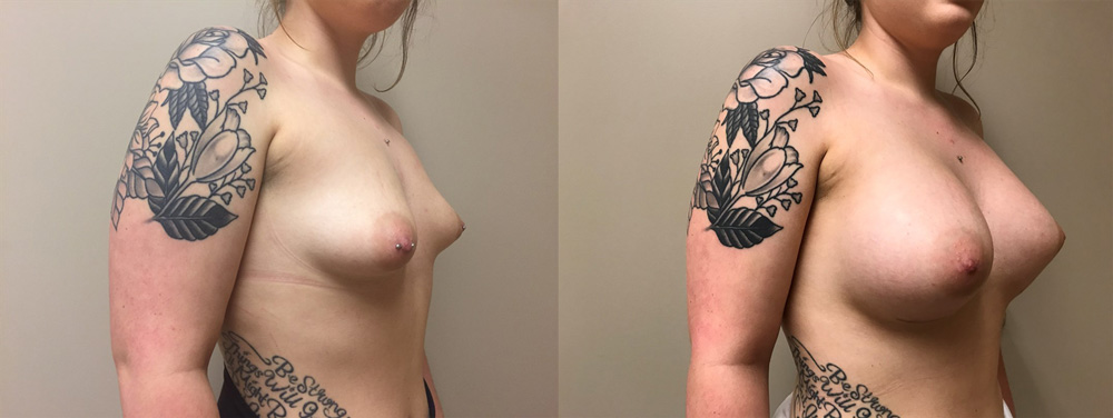 Breast Augmentation Patient 33 | Scottsdale, AZ