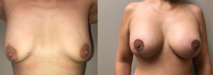 Breast Lift with Augmentation Patient 18 | Scottsdale, AZ