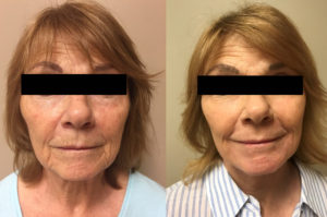 Facelift Patient 19 | Scottsdale, AZ