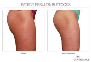Venus Legacy | Dr. Shaun Parson, Scottsdale