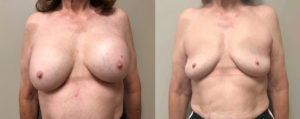 Explant Surgery Patient 2 | Scottsdale, AZ | Dr. Shaun Parson