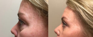 Eyelid Surgery Patient 23 | Dr. Shaun Parson Plastic Surgery, Scottsdale, Arizona