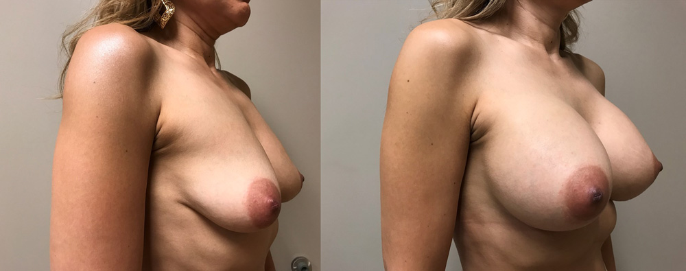 Breast Augmentation Patient 35 | Dr. Shaun Parson Plastic Surgery, Scottsdale, Arizona