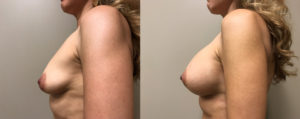 Breast Augmentation Patient 35 | Dr. Shaun Parson Plastic Surgery, Scottsdale, Arizona