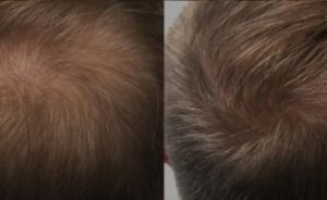 Video Hair Loss | Dr. Shaun Parson Plastic Surgery and Skin Center, Scottsdale
