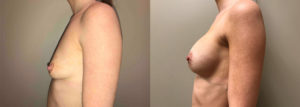 Breast Lift Peri Aug Patient 33 | Dr. Shaun Parson Plastic Surgery Scottsdale Arizona