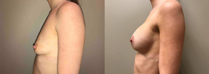 Breast Lift Peri Aug Patient 33 | Dr. Shaun Parson Plastic Surgery Scottsdale Arizona
