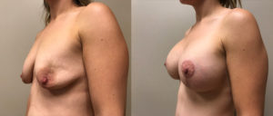 Mommy Makeover Patient 4 | Dr. Shaun Parson Plastic Surgery Scottsdale Arizona