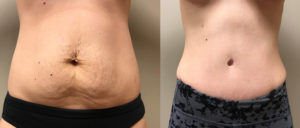 Mommy Makeover Patient 4 | Dr. Shaun Parson Plastic Surgery Scottsdale Arizona