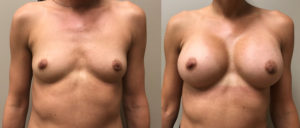 Breast Augmentation Patient 36 | Dr. Shaun Parson Plastic Surgery Scottsdale Arizona