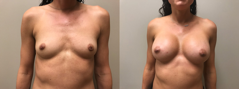 Breast Augmentation Patient 36 | Scottsdale Plastic Surgeon