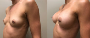 Breast Augmentation Patient 36 | Dr. Shaun Parson Plastic Surgery Scottsdale Arizona