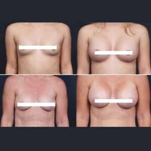 Breast Implant Photos | Dr. Shaun Parson Scottsdale, AZ