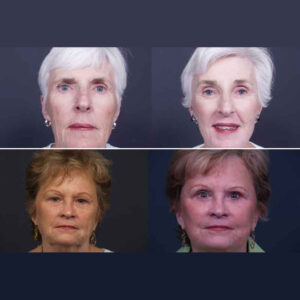 Facelift Photos | Dr. Shaun Parson Scottsdale, AZ