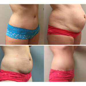 Tummy Tuck Photos | Dr. Shaun Parson Scottsdale, AZ
