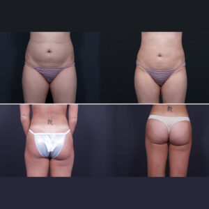Liposuction Photos | Dr. Shaun Parson Scottsdale, AZ