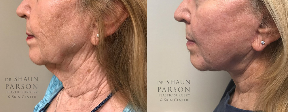 Facelift Patient 20 | Dr. Shaun Parson Scottsdale, AZ