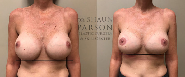 Breast Revision Patient 13 | Dr. Shaun Parson Plastic Surgery, Scottsdale, Arizona