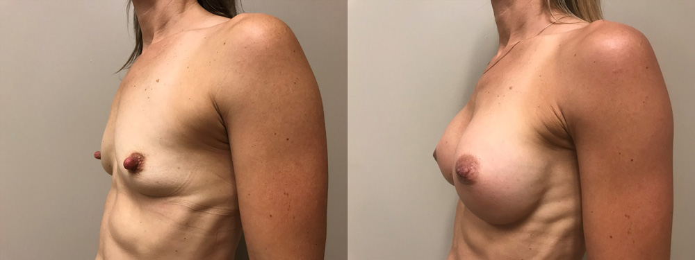 Breast Augmentation Patient 38 | Dr. Shaun Parson Plastic Surgery, Scottsdale, Arizona