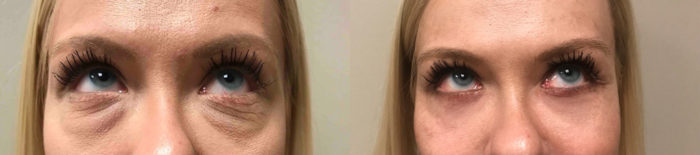 Eyelid Surgery Patient 26 | Scottsdale Plastic Surgeon