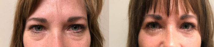Eyelid Surgery Patient 27 | Scottsdale Plastic Surgeon