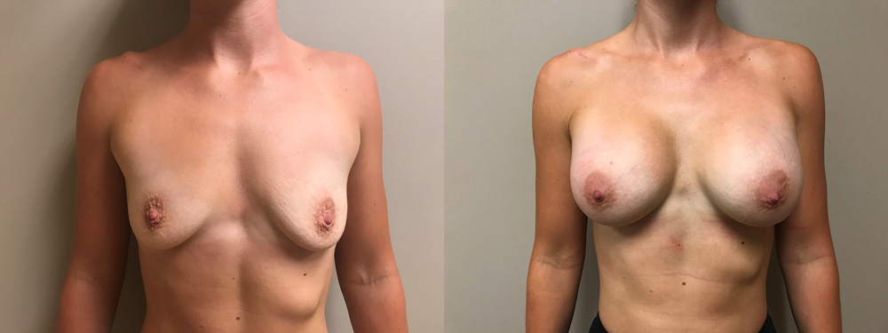 Breast Augmentation Patient 39 | Scottsdale Plastic Surgeon