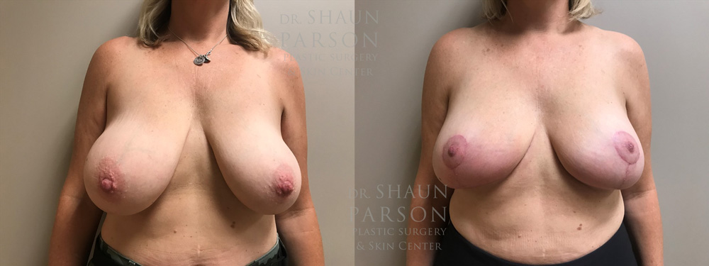 Breast Lift Patient 17 | Scottsdale Plastic Surgeon | Dr. Shaun Parson