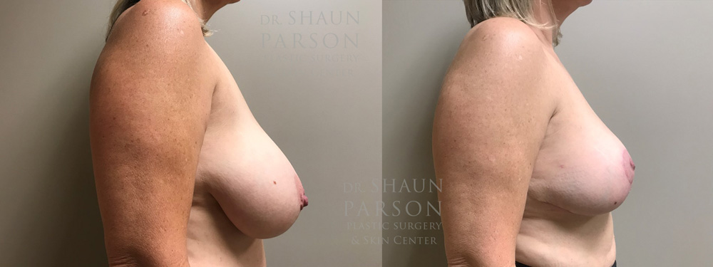 Breast Lift Patient 17 | Scottsdale Plastic Surgeon | Dr. Shaun Parson