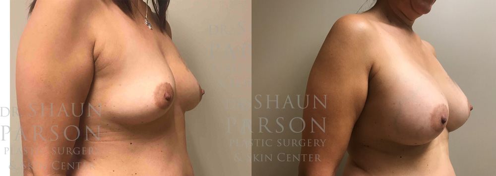 Breast Augmentation Patient 40 | Dr. Shaun Parson Scottsdale, AZ