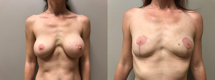 Explant Patient 6 | Scottsdale Plastic Surgeon Dr. Shaun Parson
