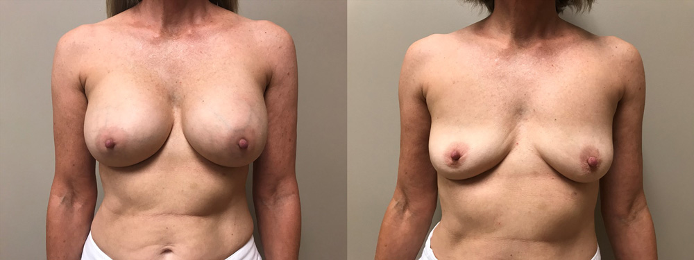 Explant Patient 5 | Scottsdale Plastic Surgeon Dr. Shaun Parson