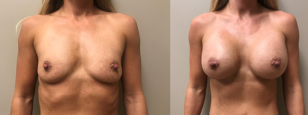 Breast Augmentation Patient 42 | Scottsdale Plastic Surgeon