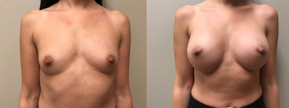 Breast Augmentation Patient 34 | Scottsdale Plastic Surgeon Dr. Shaun Parson